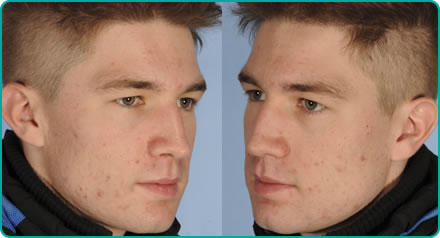Ben Wade after Acne Treatment